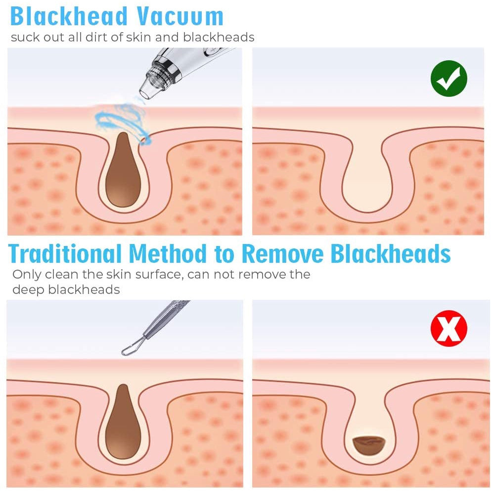 Blackhead Suction Vacuum Facial Pore Deep Cleaning Comedone Tool USB Rechargeable - Bubble + Blue Light Beauty efreshme   